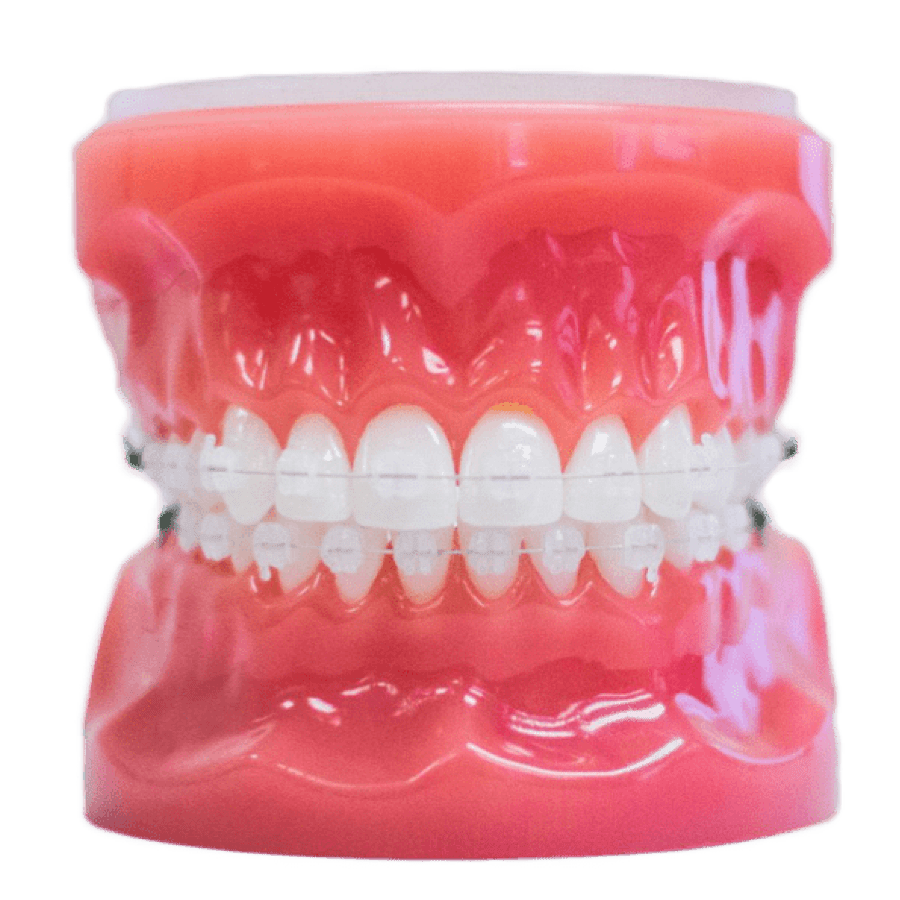 clear braces model