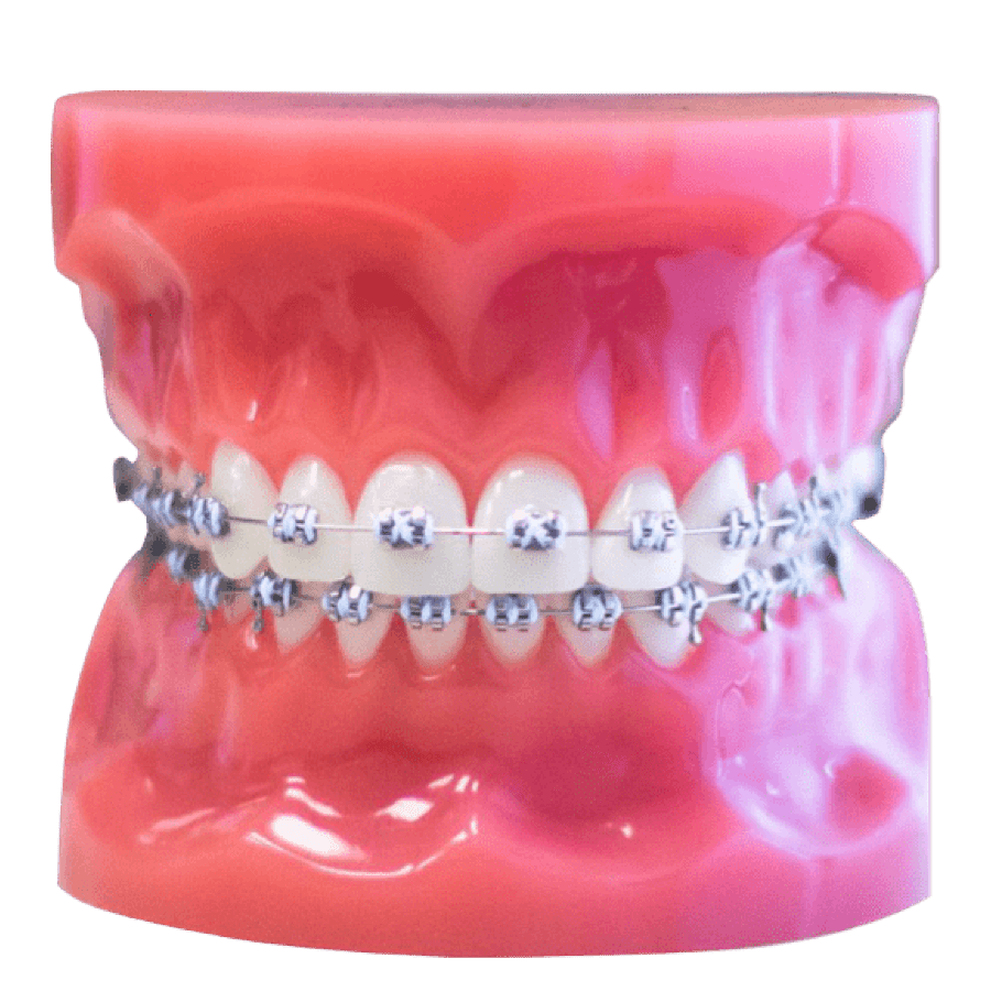 metal braces model