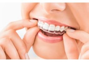 The Different Types Of Braces